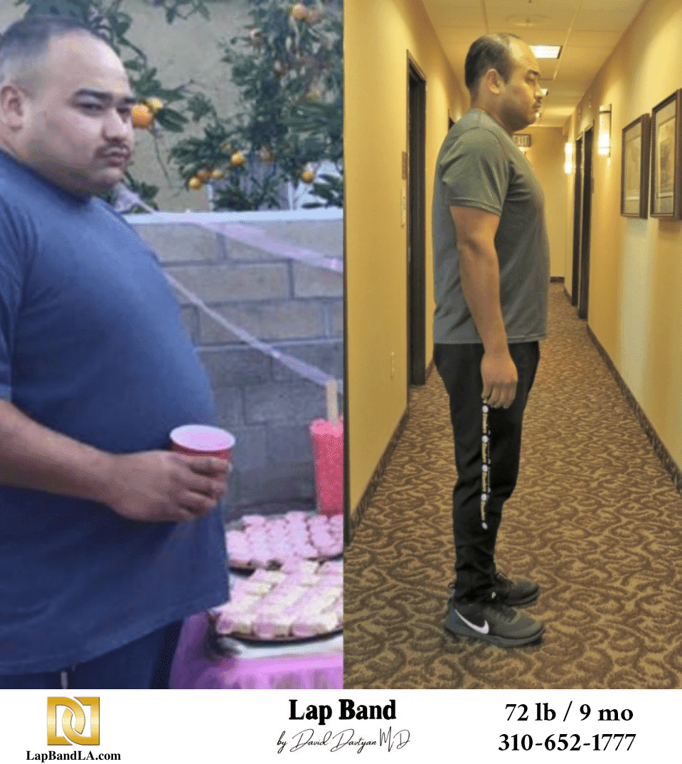 Abe Bariatric Surgery Before And After Los Angeles