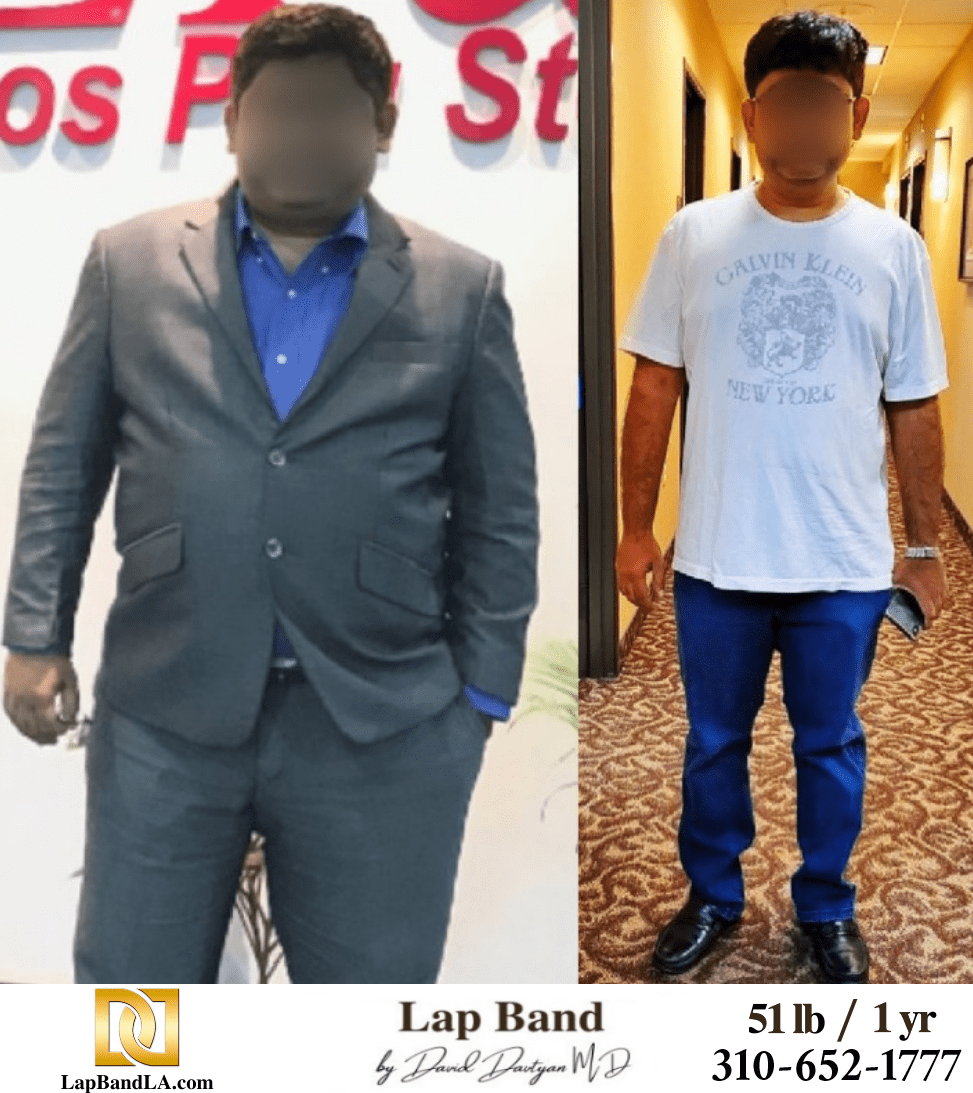 K.K. Bariatric Surgery before and after los angeles