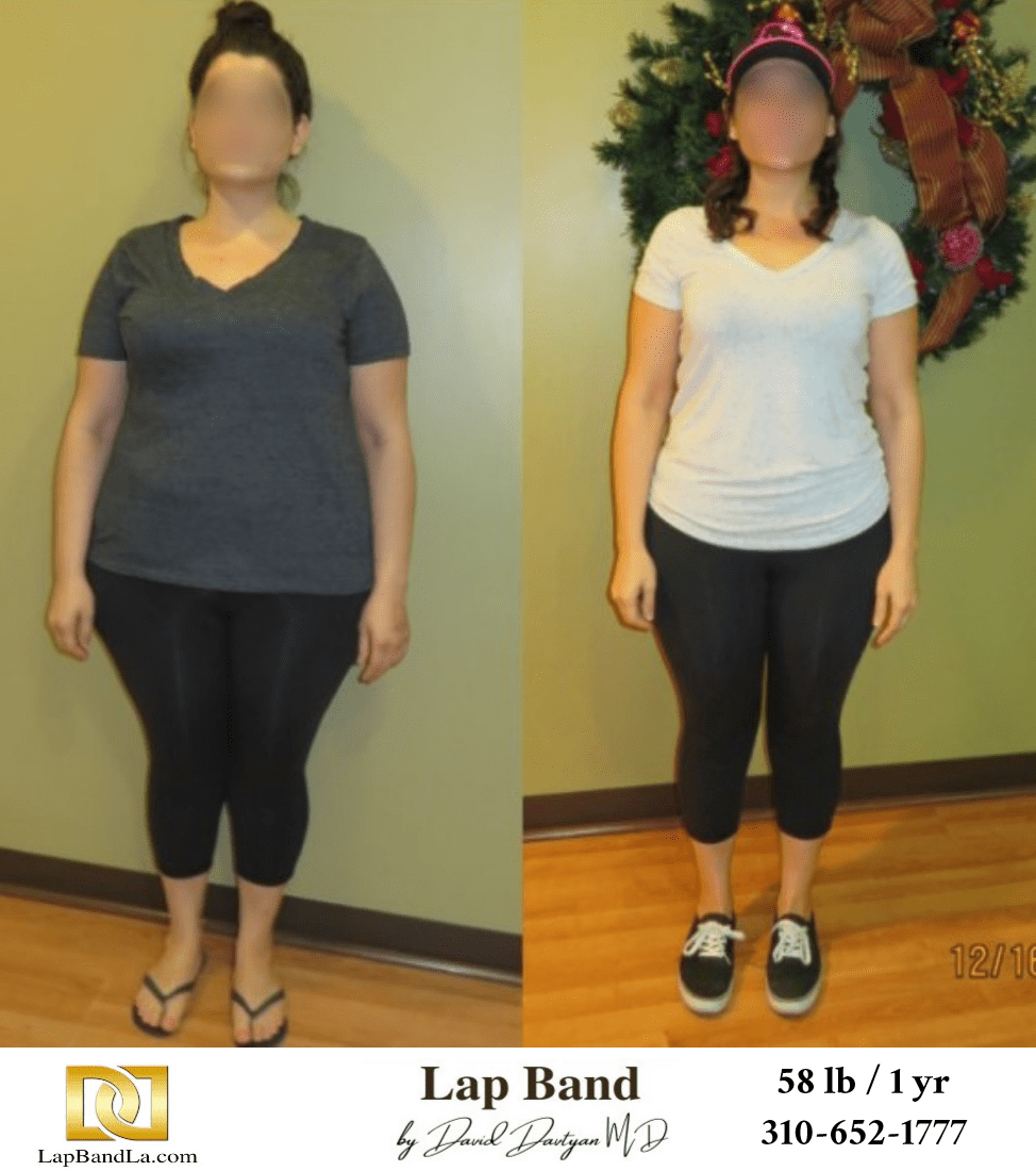 N.H. Bariatric Surgery before and after los angeles