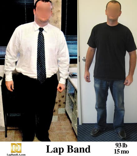 Michael G. Bariatric Surgery before and after los angeles