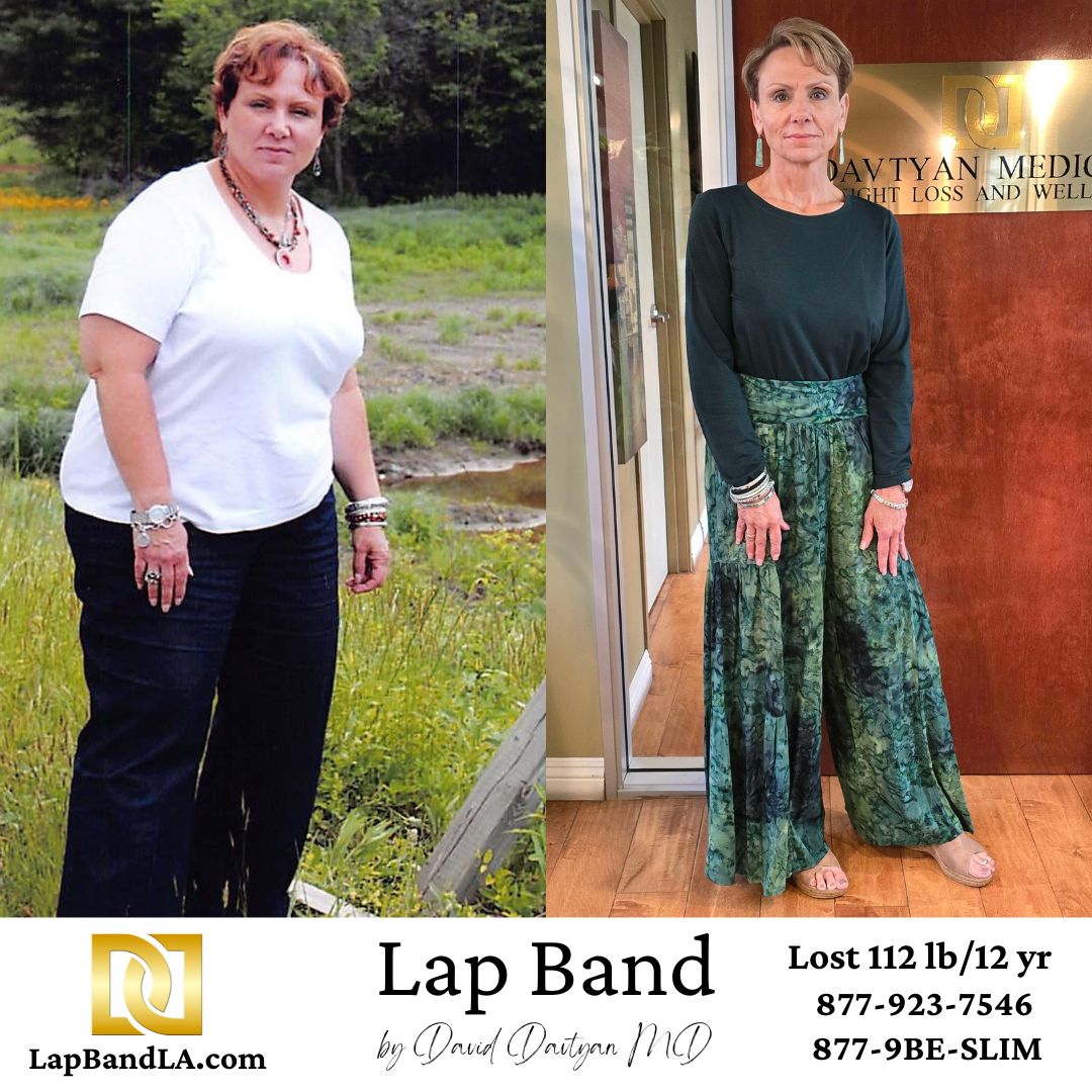 Bariatric Lap Band Surgery of Debra Before and After