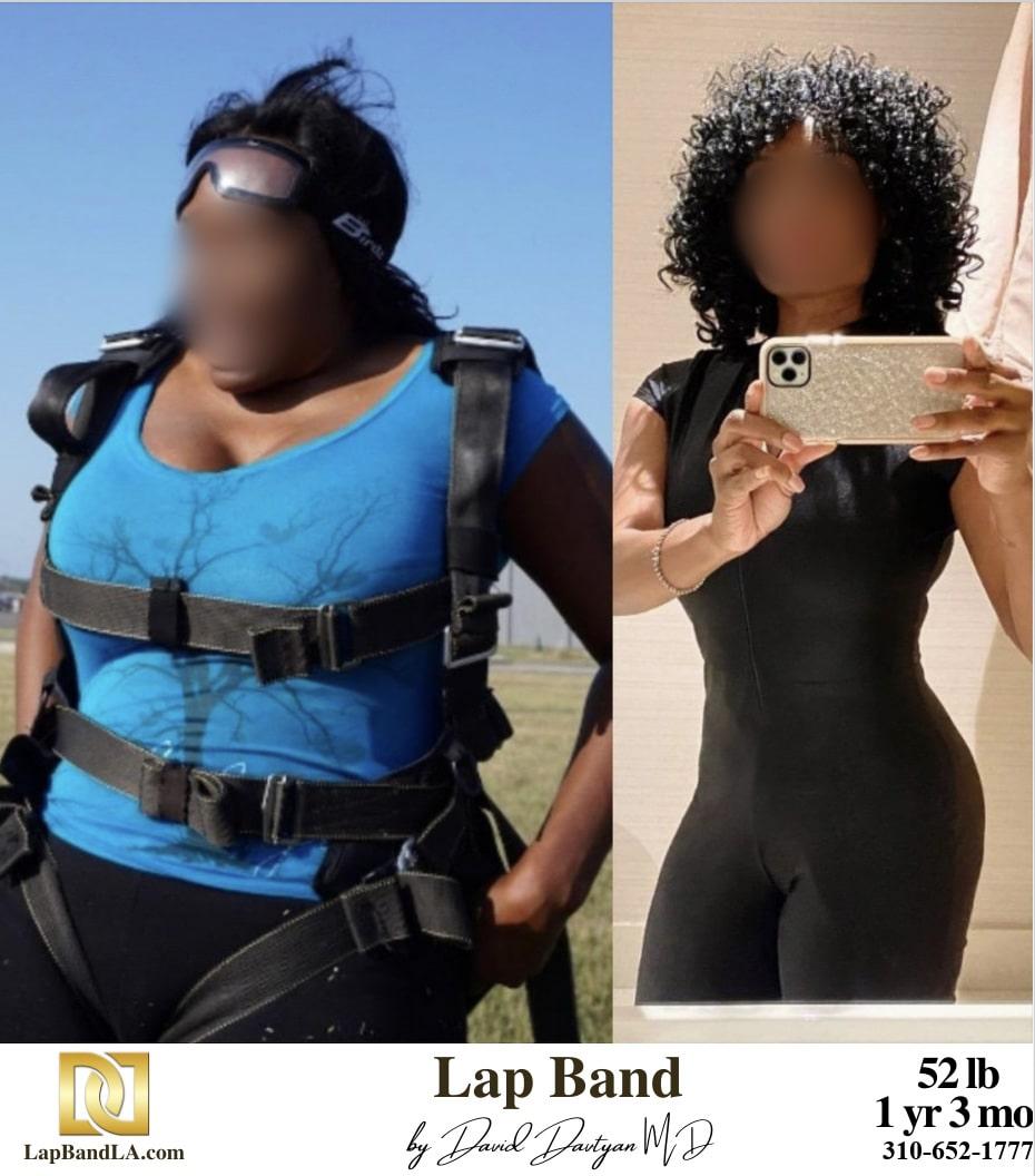 Lap band patient before and after