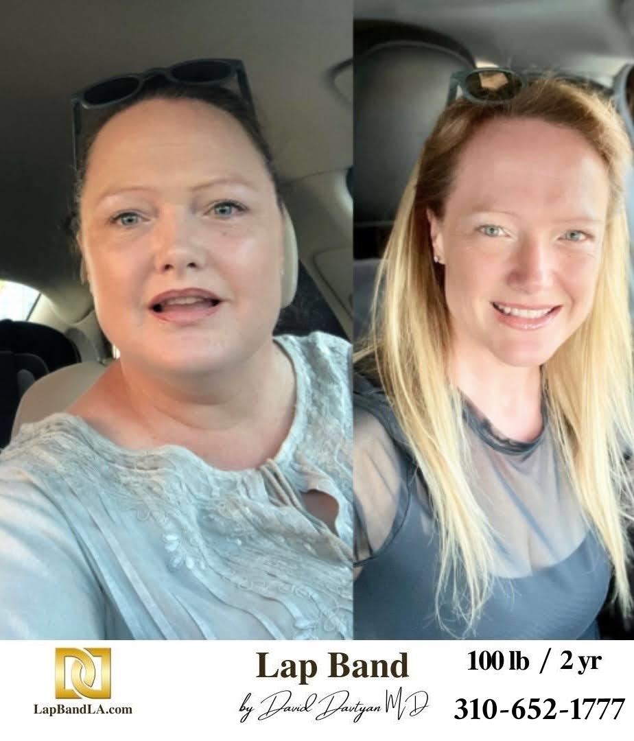 Lap Band Before After Bariatric Surgery Photo 1 32