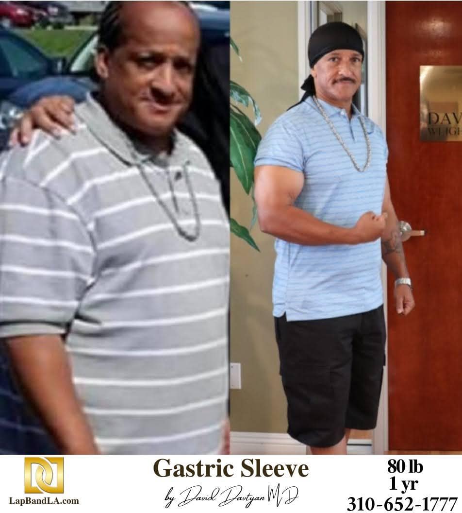 Gastric Sleeve Before and After