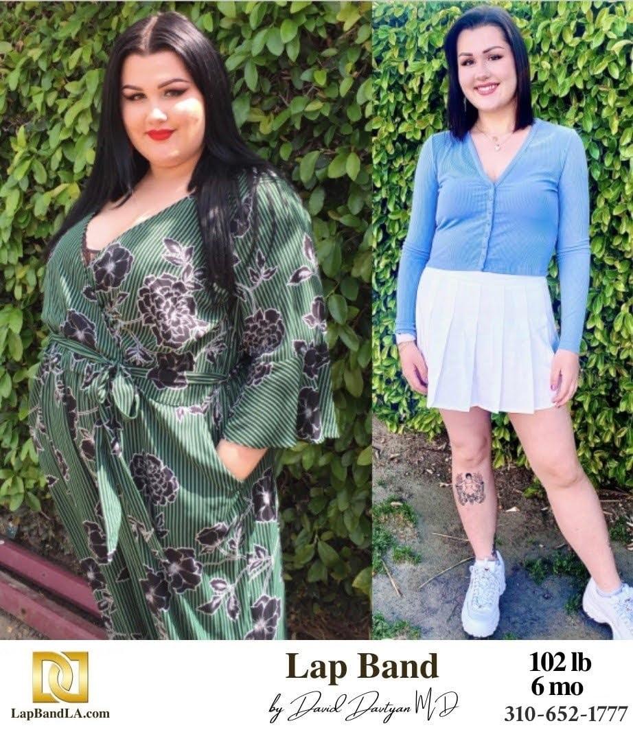 Brighton T Lap Band Before After Bariatric Surgery